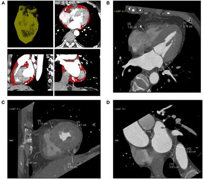 Epicardial Adipose Tissue Measured From Computed Tomography Predicts Cardiac Resynchronization Therapy Response in Patients With Non-ischemic Systolic Heart Failure